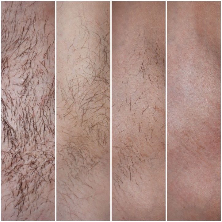 Trattamenti laser
